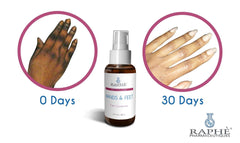 Skin Bleach Regimen before and after 30 days for hands and feet treatment with 2oz bottle of Raphe Pharmaceuticals gel corrector