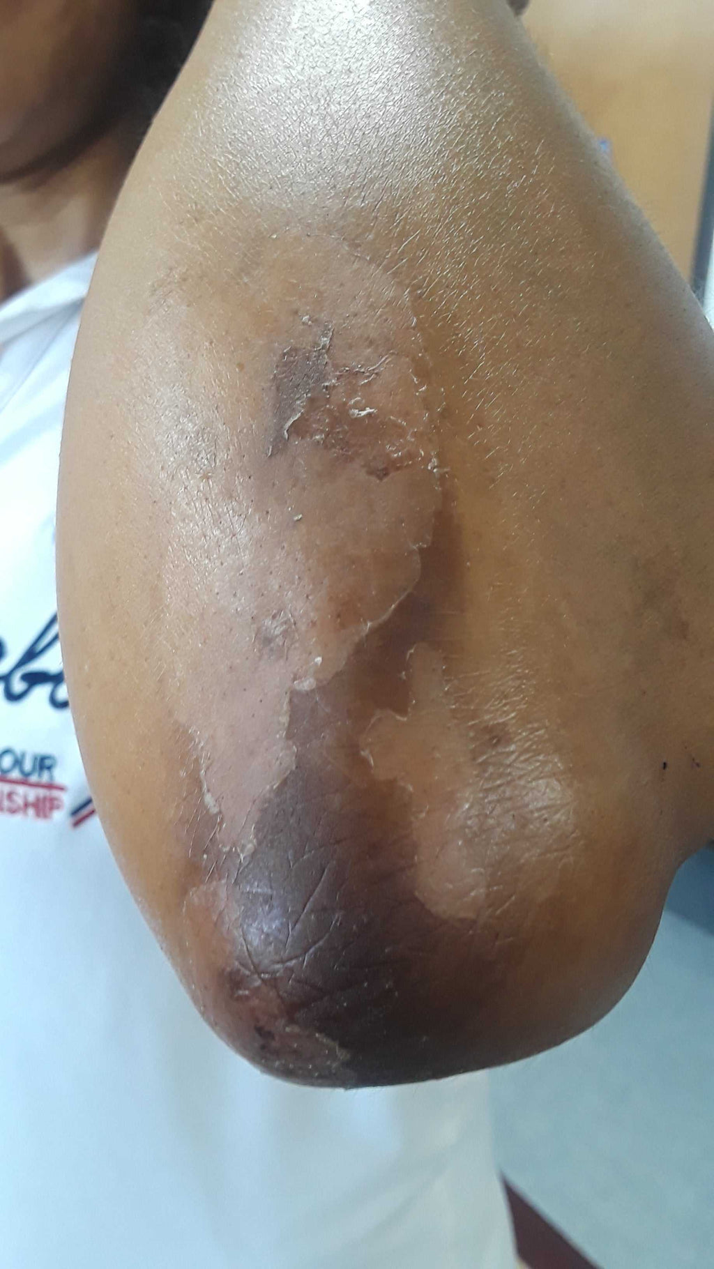 close-up of dark, peeling skin on elbow treated with solution for hydroquinone damaged skin