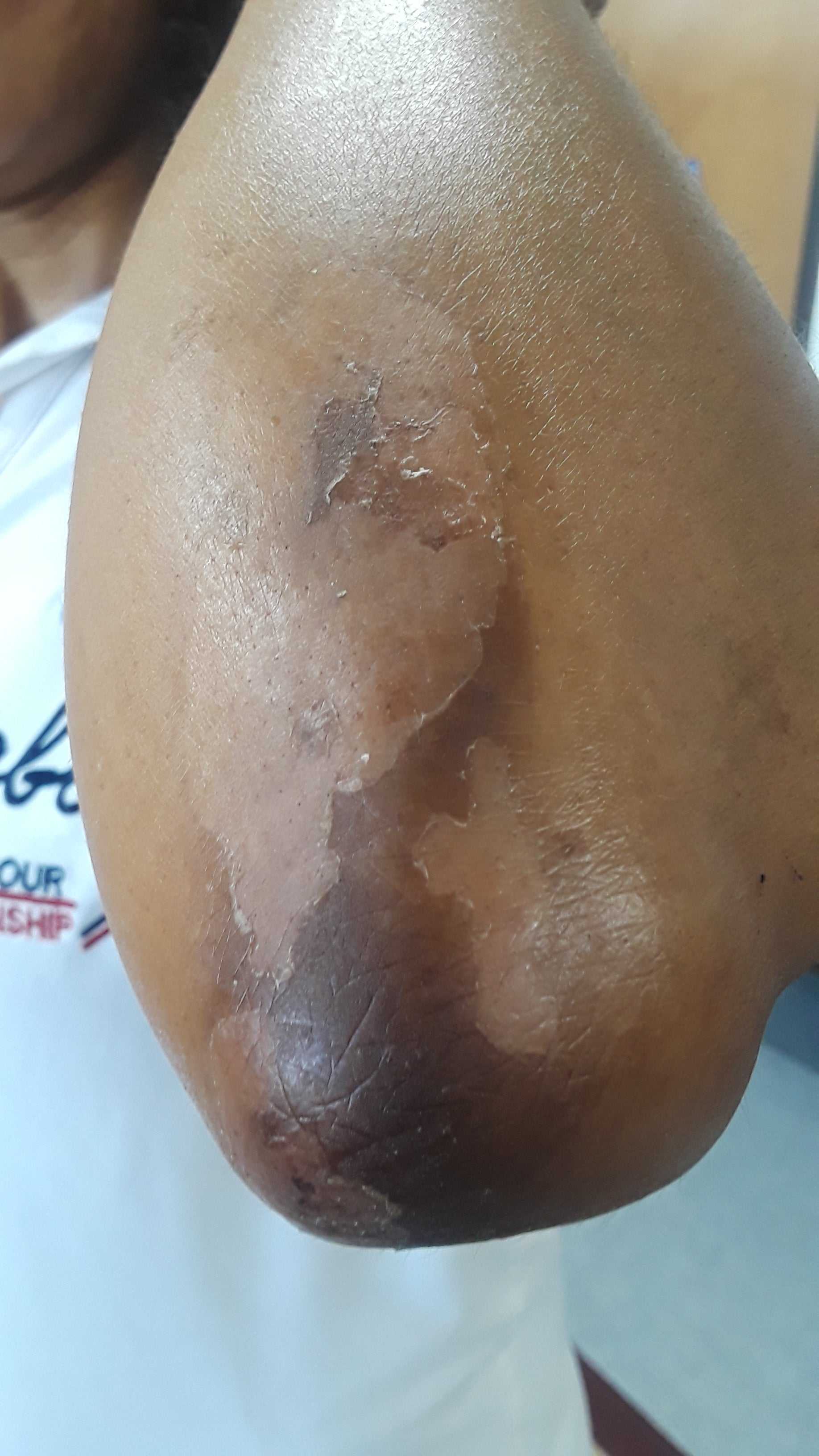 close-up of dark, peeling skin on elbow treated with solution for hydroquinone damaged skin