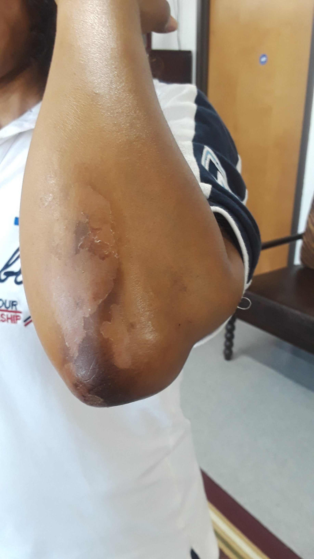 solution for elbow dark skin damaged by hydroquinone treatment on arm