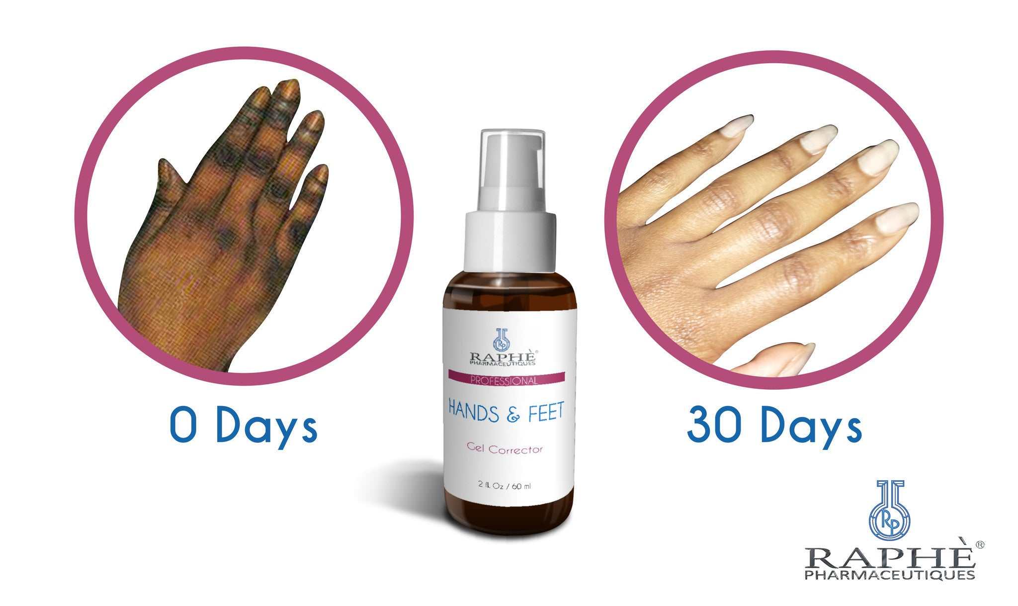 Solution for elbow, hands and feet dark skin treatment bottle with before and after 30 days results showing clear, brightened skin