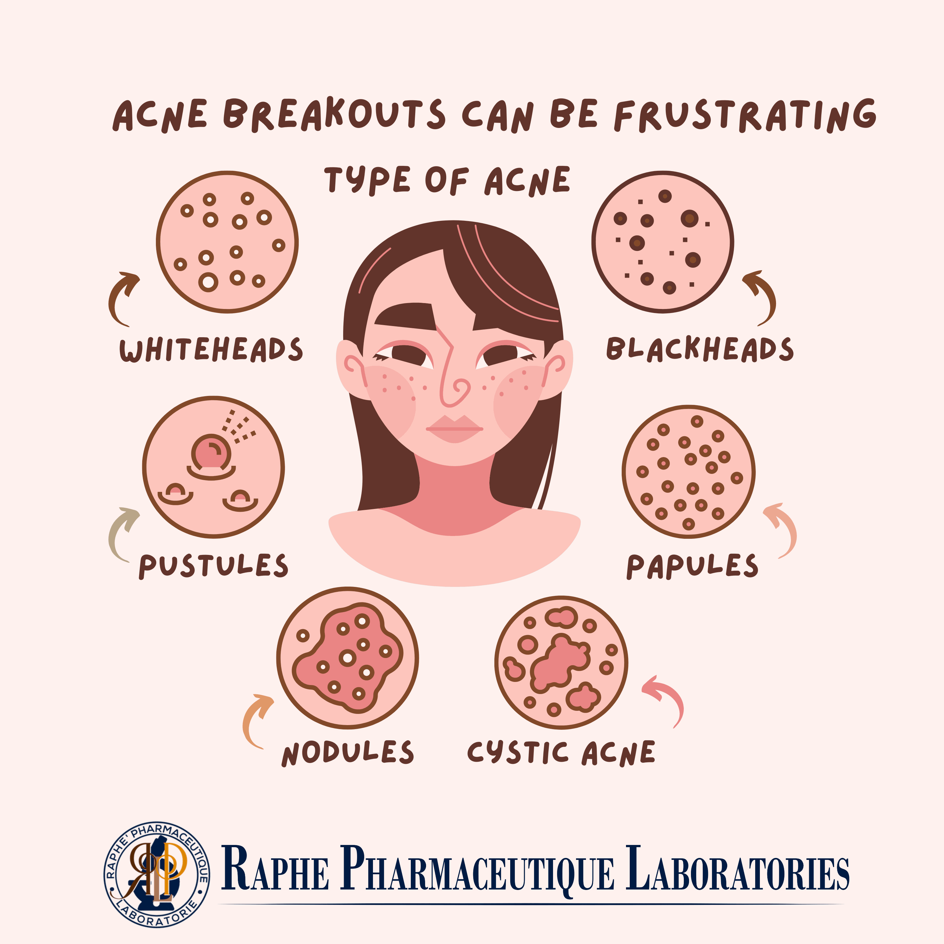 Tretinoin 0.05% Adapalene 0.03% and Salicylic acid 2% Acne Relief Gel